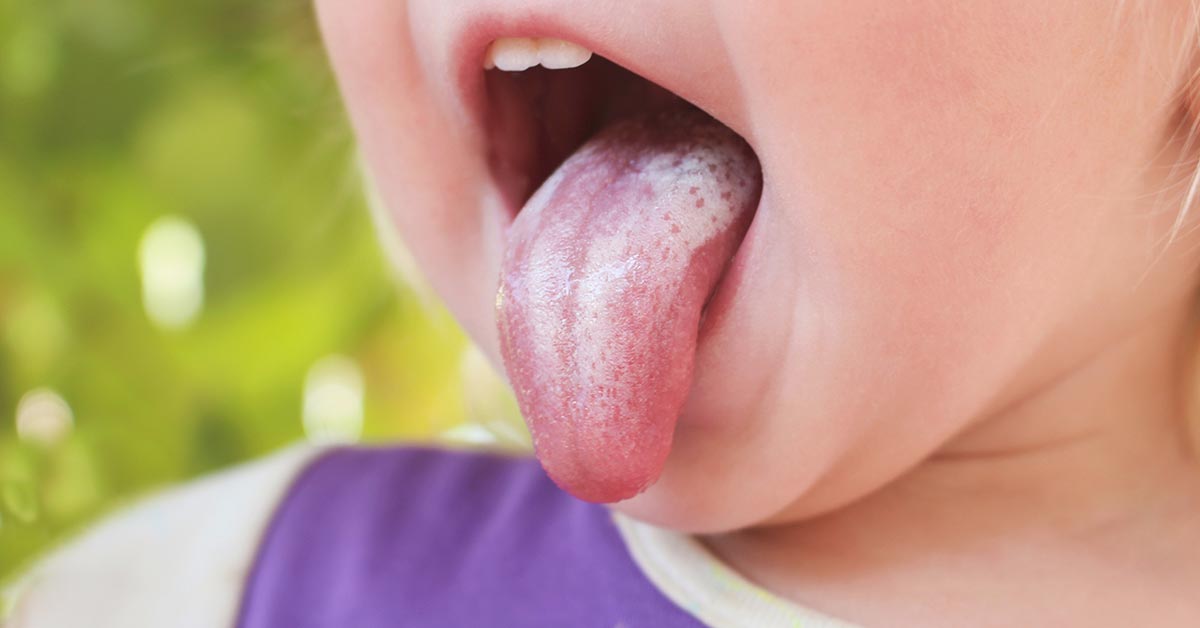 candidiasis oral manchas blancas en la lengua
