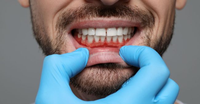 Gingivitis es contagiosa